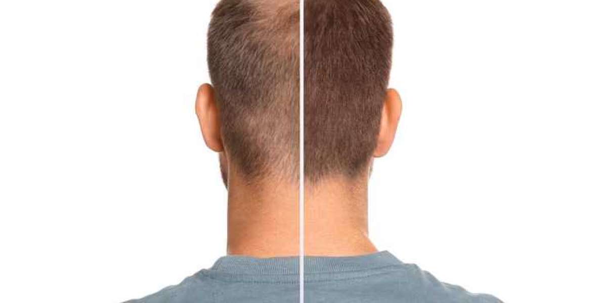 Affordable Hair Transplant Cost in Los Angeles