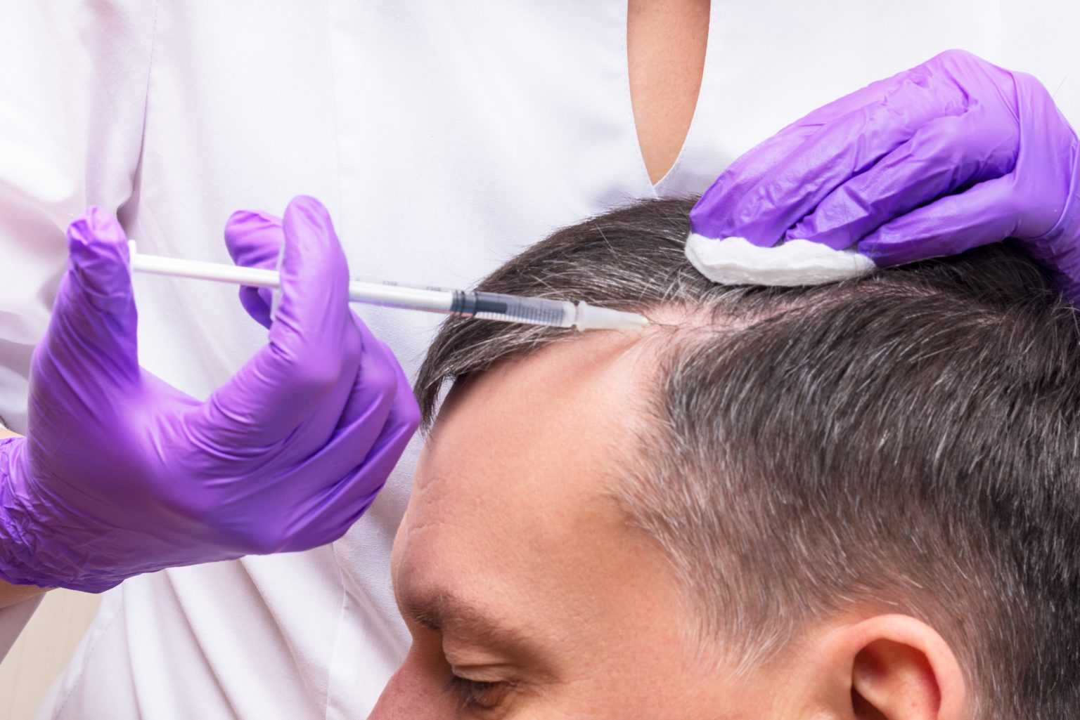 PRP hair treatment in Riyadh