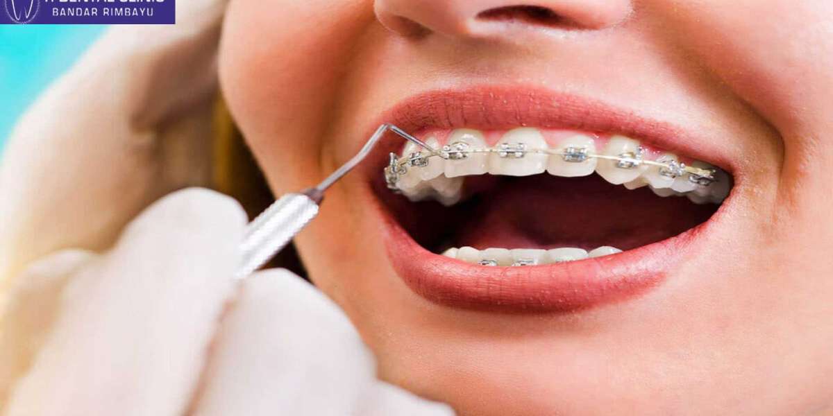 Choosing Between Invisible Braces and Traditional Braces: Finding Your Perfect Fit (Tidental)
